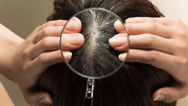 分け目はげの判断基準とは？分け目はげを改善する対策まで解説