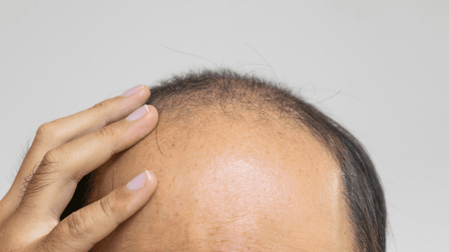 脂漏性脱毛症とは？AGAとの違いや治療法を解説