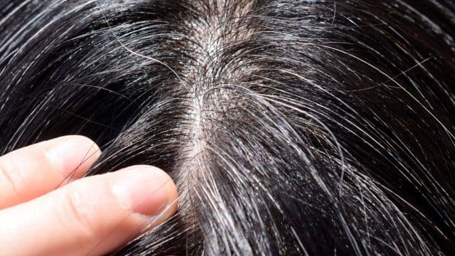 円形脱毛症の回復期に白髪が生えるのは治るサイン？原因・経過・対策を解説