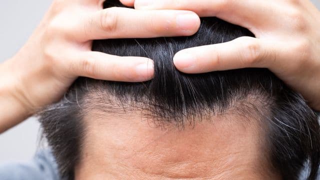 ミノキシジルはM字はげに効かない？AGAの治療効果を高める方法を解説