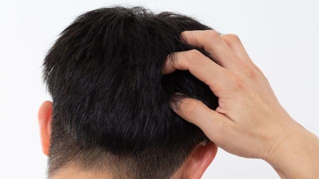 ミノキシジルでかぶれた？原因と正しい対処法について解説