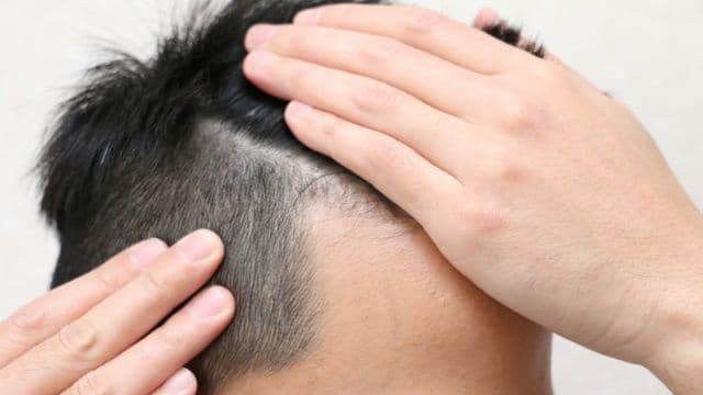 フィナステリドはM字ハゲに効く？生え際への効果を解説