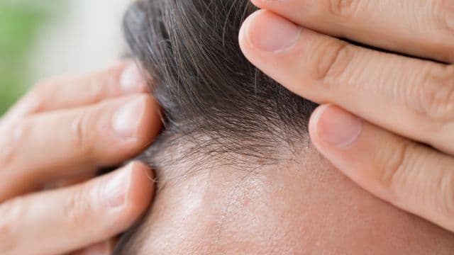 フィナステリドは生え際の薄毛に効果的？AGA治療のポイントを解説
