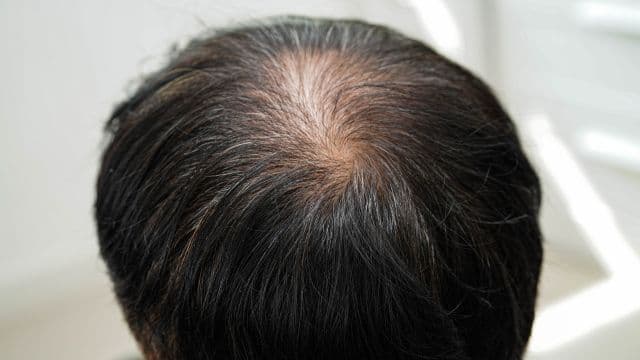 はげ方のパターンは？はげの種類は？原因や改善法、セルフチェック法を解説
