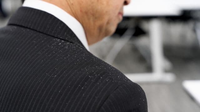ストレスでフケはできる？種類や対処法を解説