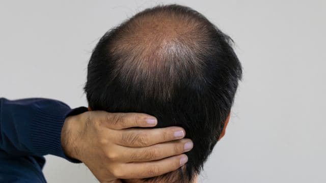 頭頂部薄毛（つむじはげ）の主な原因とは？自宅でできる対策と治療法を解説