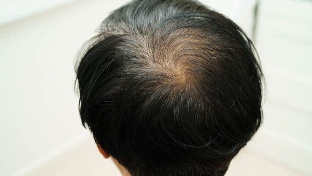 頭皮が透けて見える原因は？AGAのチェック方法やセルフケア・治療法を解説