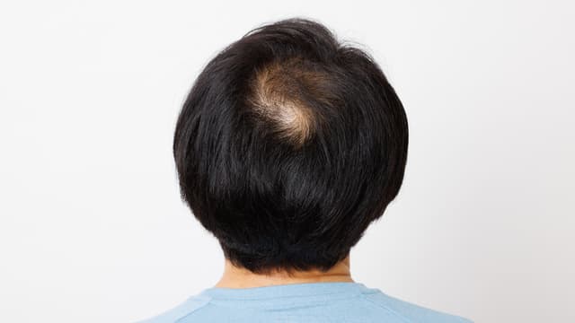 つむじはげの初期症状とは？原因と対策を紹介