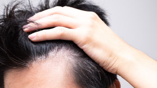 M字はげの前兆とは？初期サインの見分け方と進行を防ぐ対処法を紹介