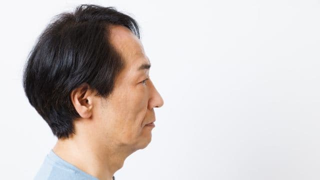 側頭部の薄毛の原因はAGAではない？6つの原因と改善方法を紹介