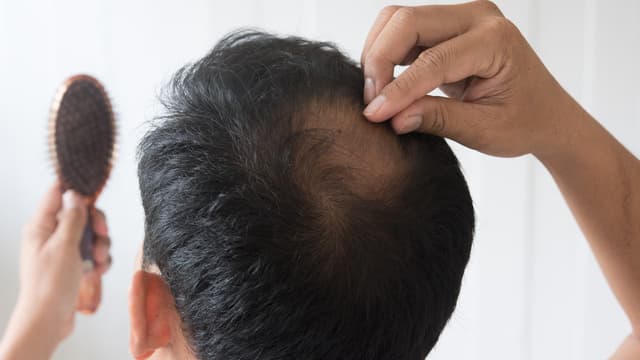 デュタステリドは頭頂部の薄毛に効く？効果・期間を解説