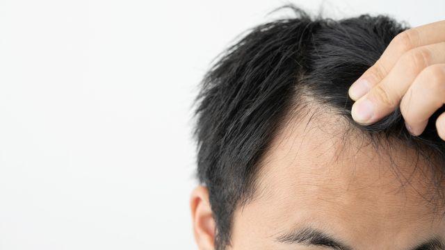 男性ホルモンが多いとはげる？薄毛になる原因をわかりやすく解説