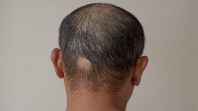 円形脱毛症が止まらない理由とは？治療法や治る前兆を解説