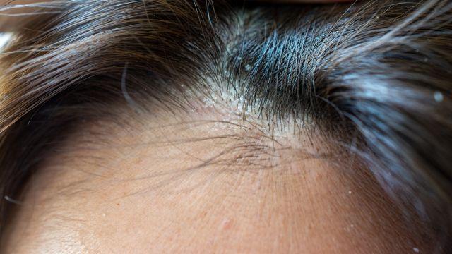 頭皮の湿疹の原因は？治療方法と予防方法について紹介