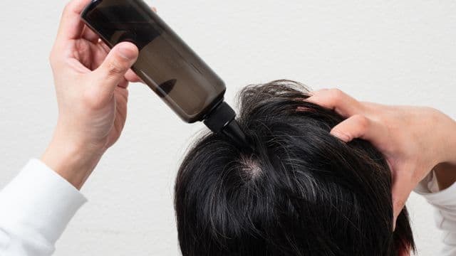 つむじはげ（頭頂部の薄毛）の治し方は？隠す方法や判断基準・原因も紹介