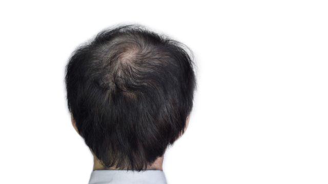 後頭部のはげへの効果的な対策とは？薄毛の原因やAGAとの関係も解説