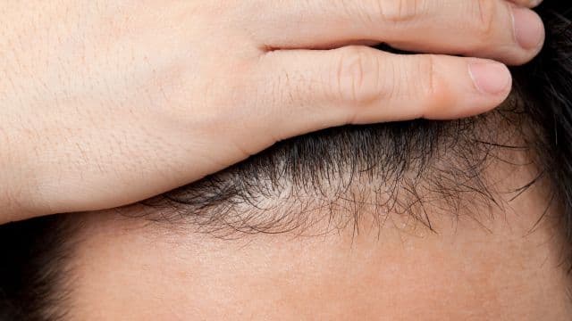 生え際の産毛はAGAの初期症状？原因や治療法、セルフケアについて解説