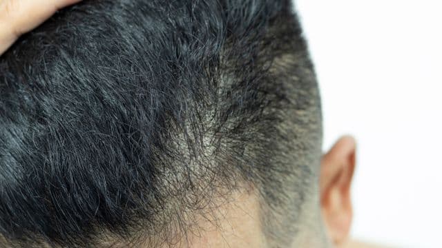 自毛植毛とは？仕組みやメリット・デメリット、費用、人工植毛との違いを解説