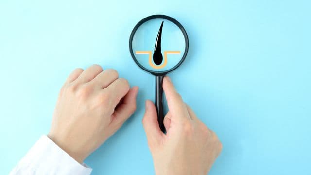 AGA治療の初期脱毛とは？抑制するための対策も紹介