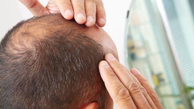 U字はげとは？原因や前兆、治療方法を解説