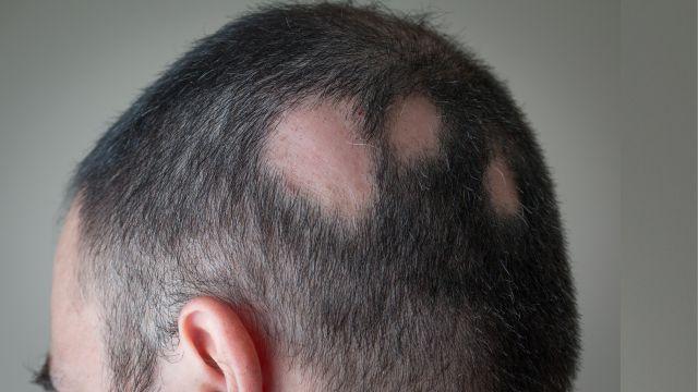 円形脱毛症の多発型は完治できる？原因と治療法を詳しく解説