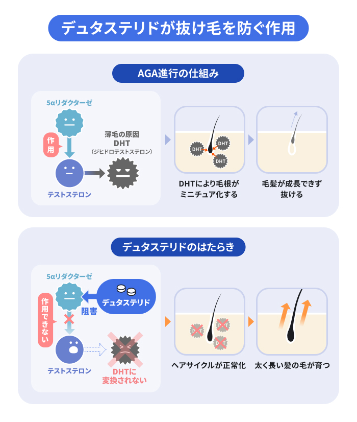 デュタステリドの作用を示したイラスト。デュタステリドによって5αリダクターゼI型・II型の両方が阻害されることで、DHT(ジヒドロテストステロン)の生成を抑制するメカニズムを説明。