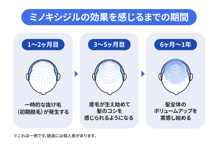ミノキシジルの効果を感じるまでの期間を示したイラスト。1〜2ヶ月目:一時的な抜け毛(初期脱毛)が発生する →3〜5ヶ月目:産毛が生え始めて髪のコシを感じられるようになる→6ヶ月〜1年:髪全体のボリュームアップを実感しはじめる