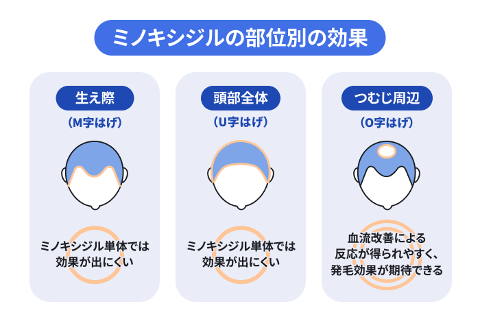 ミノキシジルの部位別の効果を示したイラスト。生え際(M字はげ):ミノキシジル単体では効果が出にくい・前頭部から頭頂部全体(U字はげ):ミノキシジル単体では効果が出にくい・つむじ周辺(O字はげ):ミノキシジルの発毛効果を感じやすい