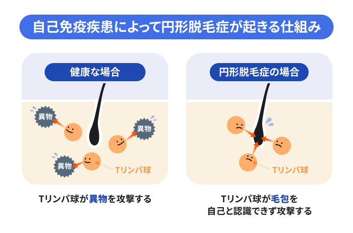円形脱毛症が自己免疫疾患によって起きる仕組み。健康な場合はTリンパ球が外部の異物を攻撃するが、円形脱毛症の場合はTリンパ球が自身の毛根を誤って攻撃してしまう様子を比較しているのイメージ
