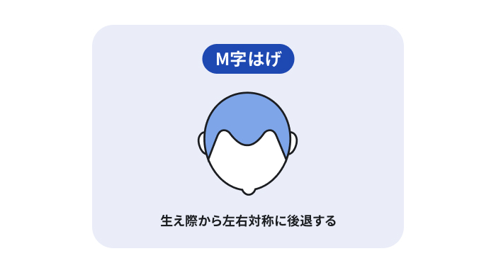 AGA(男性型脱毛症)でよく見られる「M字はげ」のはげ方を表した図。生え際から左右対称に後退する「M字はげ」をイラストで説明のイメージ