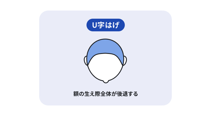 AGA(男性型脱毛症)でよく見られる「U字はげ」のはげ方を表した図。額の生え際全体が後退する「U字はげ」をイラストで説明。のイメージ