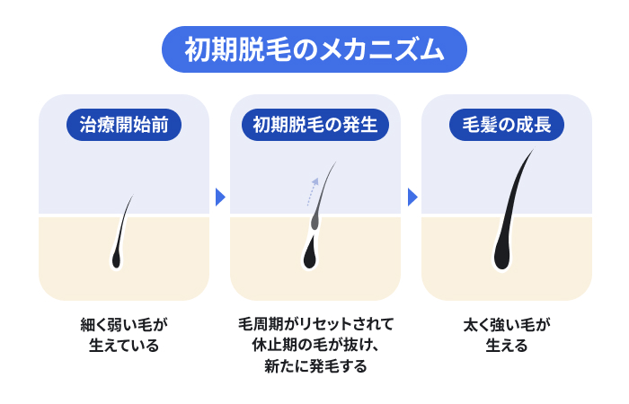 初期脱毛のメカニズムを3段階で示したイラスト。治療開始前の細い毛が、新しく生えてきた太い毛に押し出されることで初期脱毛が発生し、その後太く強い毛へ成長する3段階のプロセスを説明のイメージ
