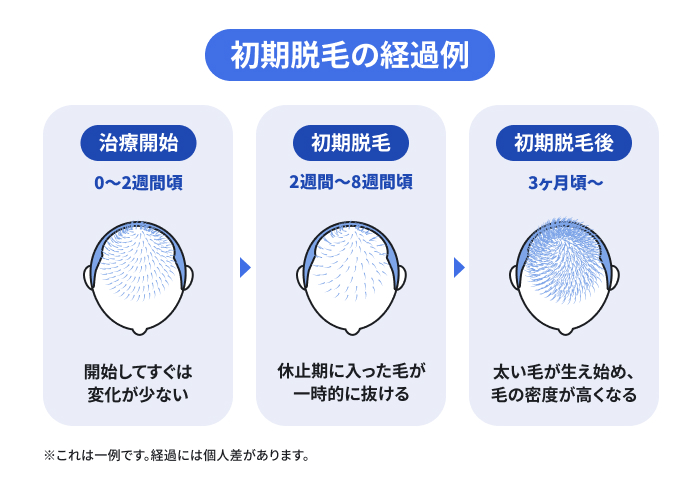 初期脱毛の経過例を頭皮のイラスト。治療開始直後の状態から、細い毛が抜ける初期脱毛期を経て、太い毛が生え揃い髪の密度が高まるまでの変化を説明のイメージ