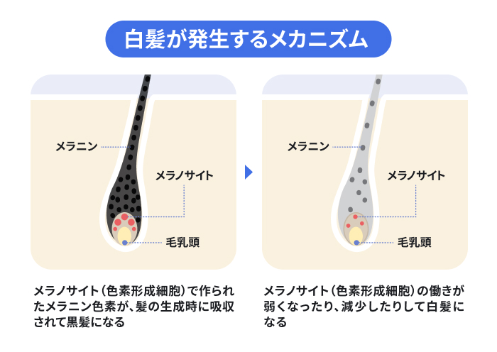 白髪が発生するメカニズムを示した図。メラノサイトがメラニン色素を生成し髪が黒くなる正常な状態と、メラノサイトの機能低下によりメラニンが供給されず白髪になる状態を比較し、白髪が生える原因を解説。