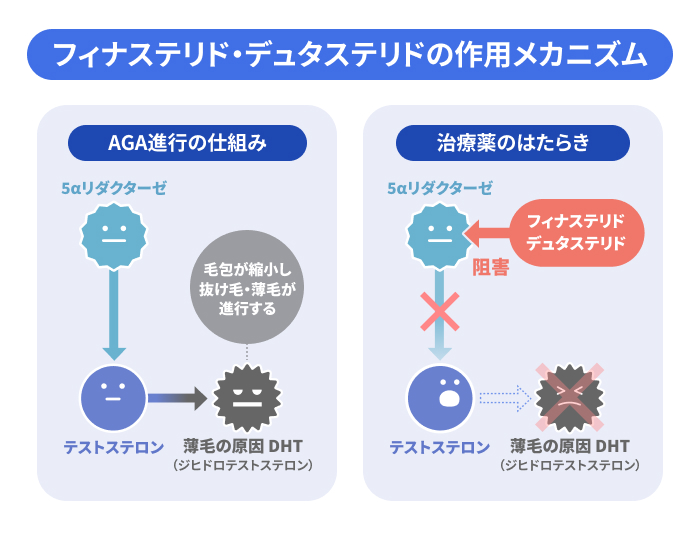 AGA進行の仕組みとフィナステリド・デュタステリドの作用機序を示した図。AGA治療薬が5αリダクターゼを阻害してDHTの生成を抑制し、進行を抑える仕組みを解説。