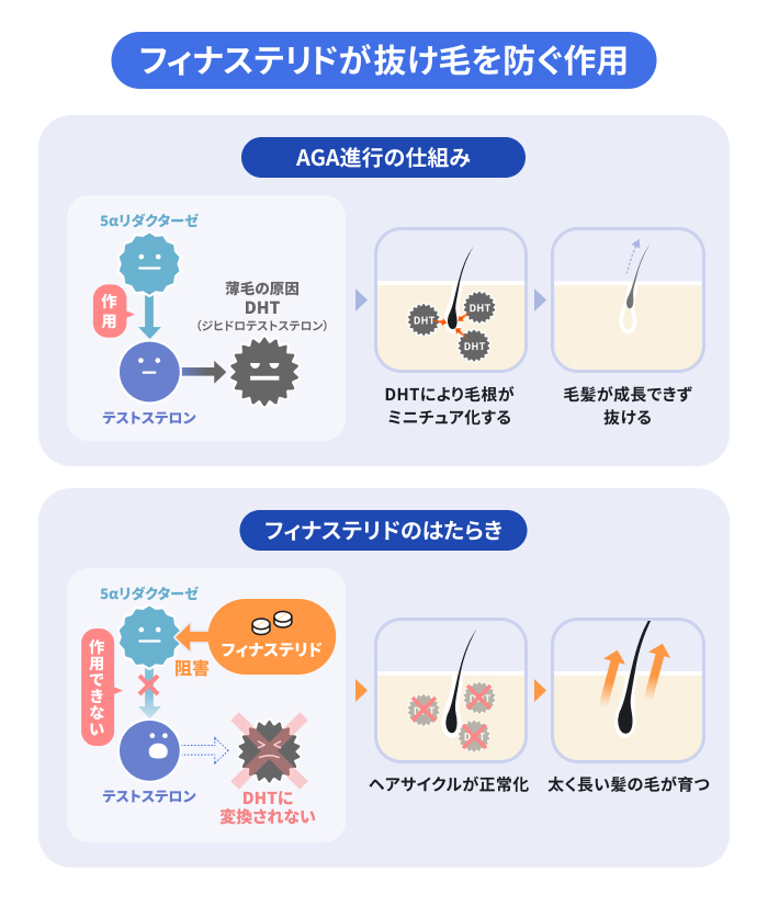 フィナステリドが抜け毛を防ぐ作用の図解。5αリダクターゼがテストステロンと結合するのを阻害し、薄毛の原因DHT(ジヒドロテストステロン)の生成を抑制する。イメージ画像