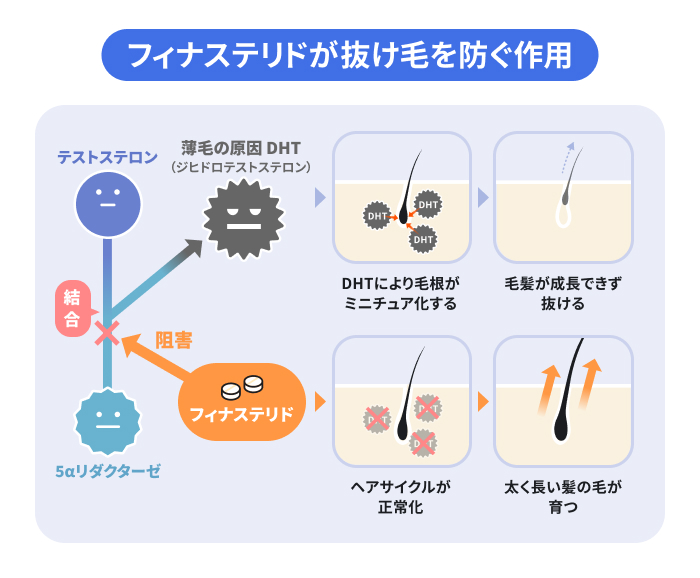 フィナステリドが抜け毛を防ぐ作用の図解。5αリダクターゼがテストステロンと結合するのを阻害し、薄毛の原因DHT(ジヒドロテストステロン)の生成を抑制するイメージ