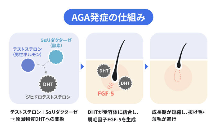 男性ホルモンのテストステロンが還元酵素5αリダクターゼの働きによってDHT(ジヒドロテストステロン)へ変換され、受容体と結合することでAGA(男性型脱毛症)が発症する仕組みのイメージ