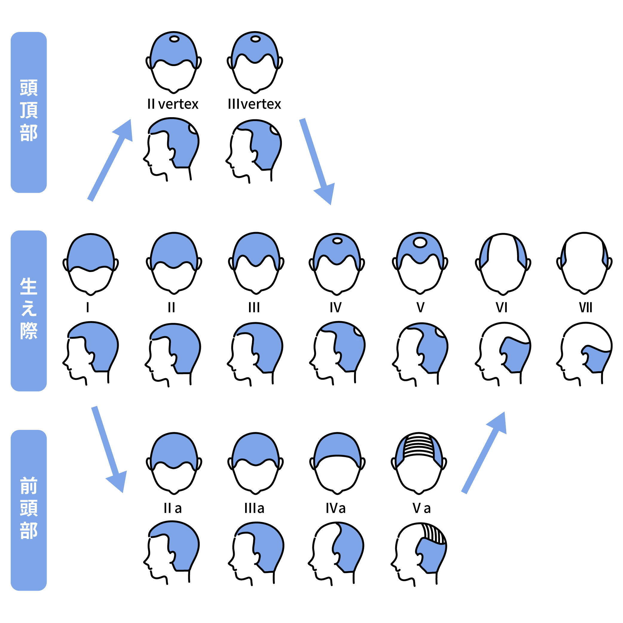 ハミルトン・ノーウッド分類によるAGAの進行パターン図。額の生え際から後退する標準的なI型〜VII型の経過に加え、頭頂部から薄くなる「vertex型(つむじ型)」、および生え際が全体的に後退する「a型(前頭部進行型)」の3つの進行ルートを段階別に図解。