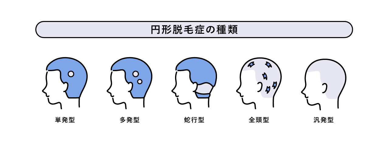 円形脱毛症の症状別の分類図。左から、1箇所が円形に脱毛する「単発型」・複数箇所が円形に脱毛する「多発型」・生え際が帯状に脱毛する「蛇行型」・脱毛が頭部全体に広がり、頭髪のすべてが抜け落ちてしまう状態「全頭型」・頭髪だけでなく、眉毛、まつ毛、体毛など全身の毛が抜ける最も進行した状態の「汎発型」を図解のイメージ
