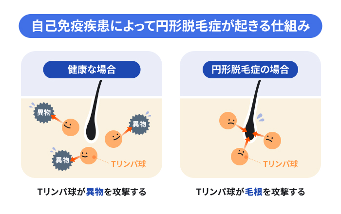 円形脱毛症が自己免疫疾患によって起きる仕組み。健康な場合はTリンパ球が外部の異物を攻撃するが、円形脱毛症の場合はTリンパ球が自身の毛根を誤って攻撃してしまう様子を比較しているのイメージ