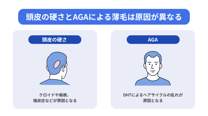 頭皮の硬さとAGAによる薄毛は原因が異なる(頭皮の硬さはケロイドや瘢痕、強皮症などが原因。AGAはDHTによるヘアサイクルの乱れが原因となる)