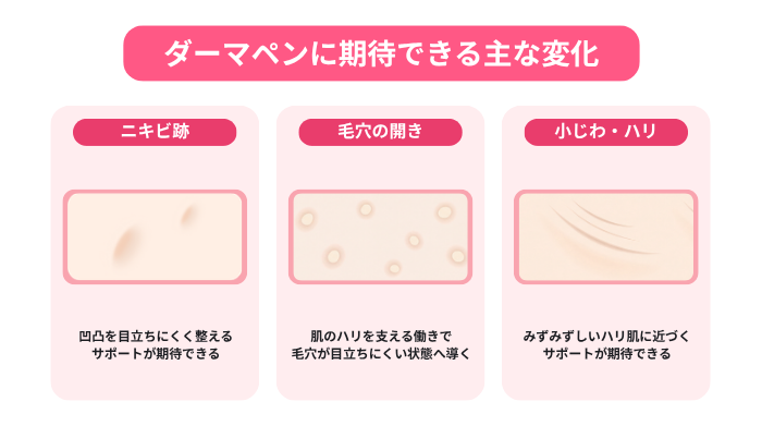 ダーマペンによる施術で期待できる主な変化として、ニキビ跡の凹凸を整えるサポート、毛穴の開きを目立ちにくくする状態への導き、小じわやハリへのアプローチを示した図。