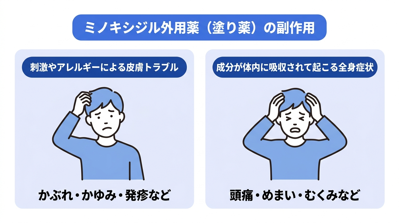 ミノキシジル外用薬(塗り薬)の副作用を、皮膚トラブルと全身症状に分けて解説。皮膚トラブルは刺激によるアレルギーでかぶれやかゆみ、発疹などが起こる可能性がある。全身症状は、頭痛やめまい、むくみなどが挙げられる。