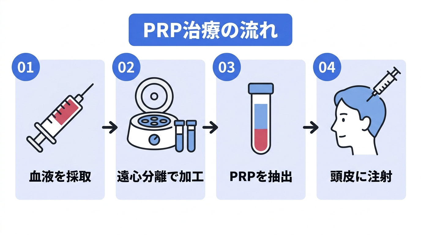 PRP治療の流れ(血液を採取、遠心分離で加工、PRPを抽出、頭皮に注射)