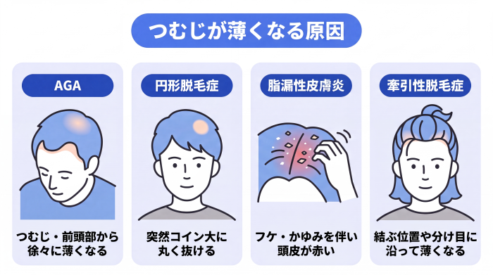 つむじが薄くなる原因を、AGAや円形脱毛症、脂漏性皮膚炎、牽引性脱毛症の4つに分類した図。脱毛の特徴や頭皮の赤み・フケといった症状の違いを比較して解説する。