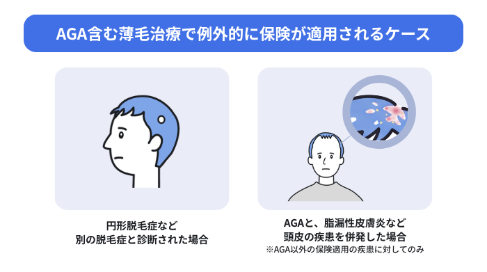 AGAを含む薄毛治療で例外的に保険が適用されるケースを解説。円形脱毛症など別の脱毛症と診断された場合と、AGAと脂漏性皮膚炎など頭皮の疾患を併発した場合。