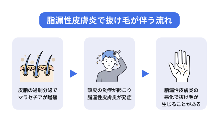 脂漏性皮膚炎で抜け毛が伴う流れのイメージ図。皮脂の過剰分泌でマラセチアが増殖。頭皮の炎症が起こり脂漏性皮膚炎が発症。脂漏性皮膚炎の悪化で抜け毛が生じることがある。