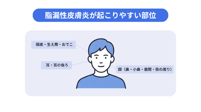脂漏性皮膚炎が起こりやすい部位のイメージ図。頭皮・生え際・おでこ、耳・耳の後ろ、顔(鼻・小鼻・眉間・目の周り)