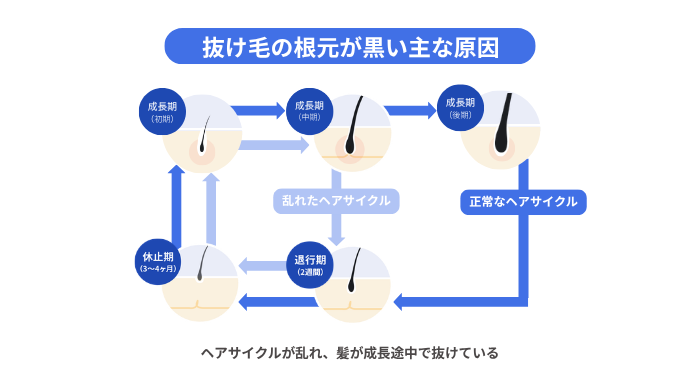 抜け毛の根元が黒い主な原因を解説する図解。ヘアサイクルが乱れ、成長期の途中で髪が抜けてしまうことで、毛根が黒いまま脱落するメカニズムを示している。正常なヘアサイクルとの違いを比較し、なぜ抜け毛の毛根が黒くなるのかを視覚的に表現している。